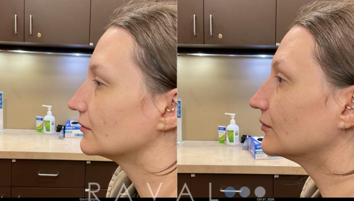 Before & After Botox & Dermal Fillers Case 1192 View 1 View in Denver, CO