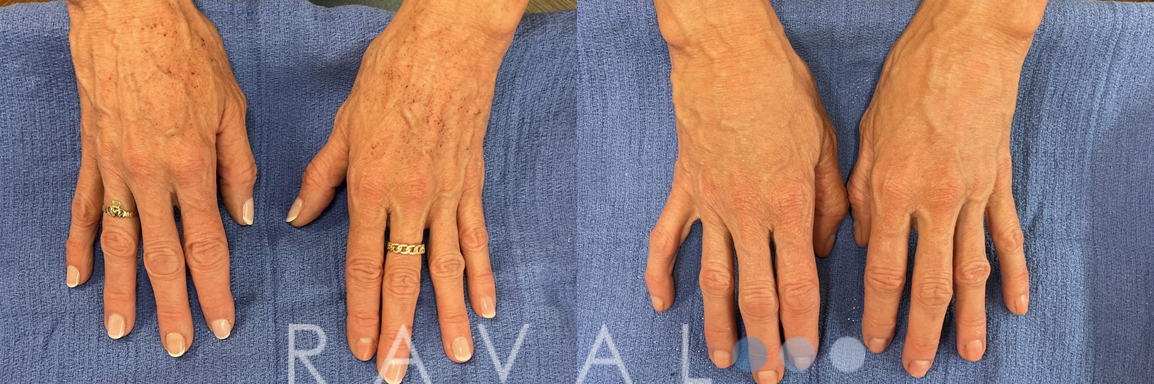 Before & After Botox & Dermal Fillers Case 1193 View 1 View in Denver, CO