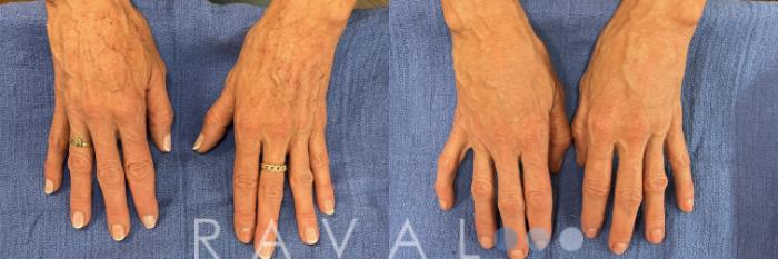 Before & After Botox & Dermal Fillers Case 1193 View 1 View in Denver, CO