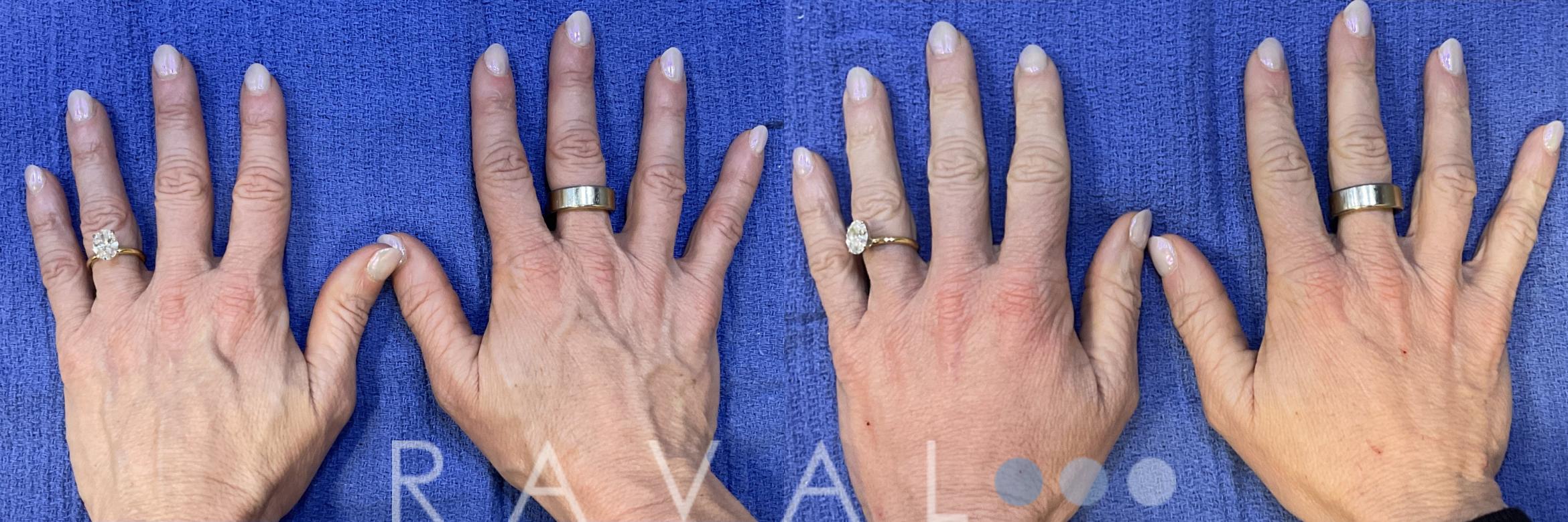 Before & After Botox & Dermal Fillers Case 1194 View 1 View in Denver, CO