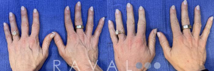 Before & After Botox & Dermal Fillers Case 1194 View 1 View in Denver, CO