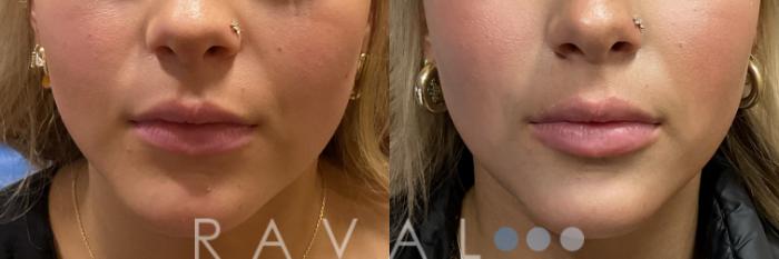 Before & After Botox & Dermal Fillers Case 1195 View 1 View in Denver, CO