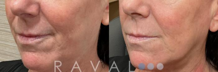 Before & After Botox & Dermal Fillers Case 1196 View 1 View in Denver, CO