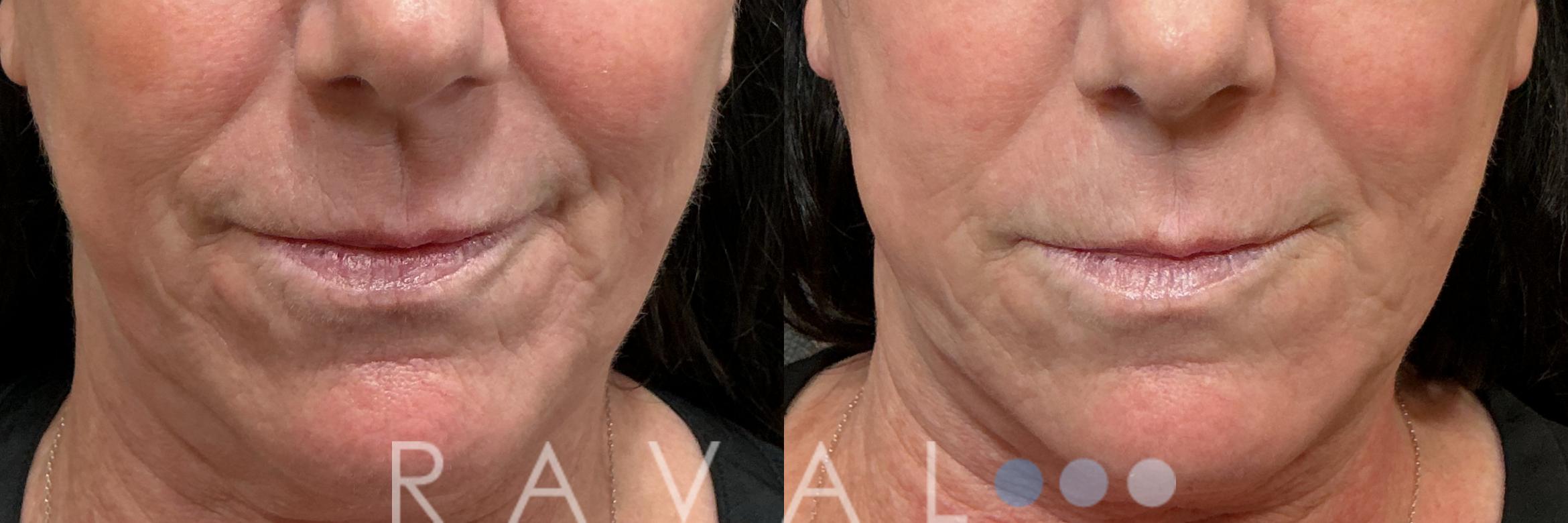Before & After Botox & Dermal Fillers Case 1196 View 2 View in Denver, CO