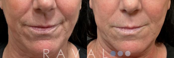 Before & After Botox & Dermal Fillers Case 1196 View 2 View in Denver, CO