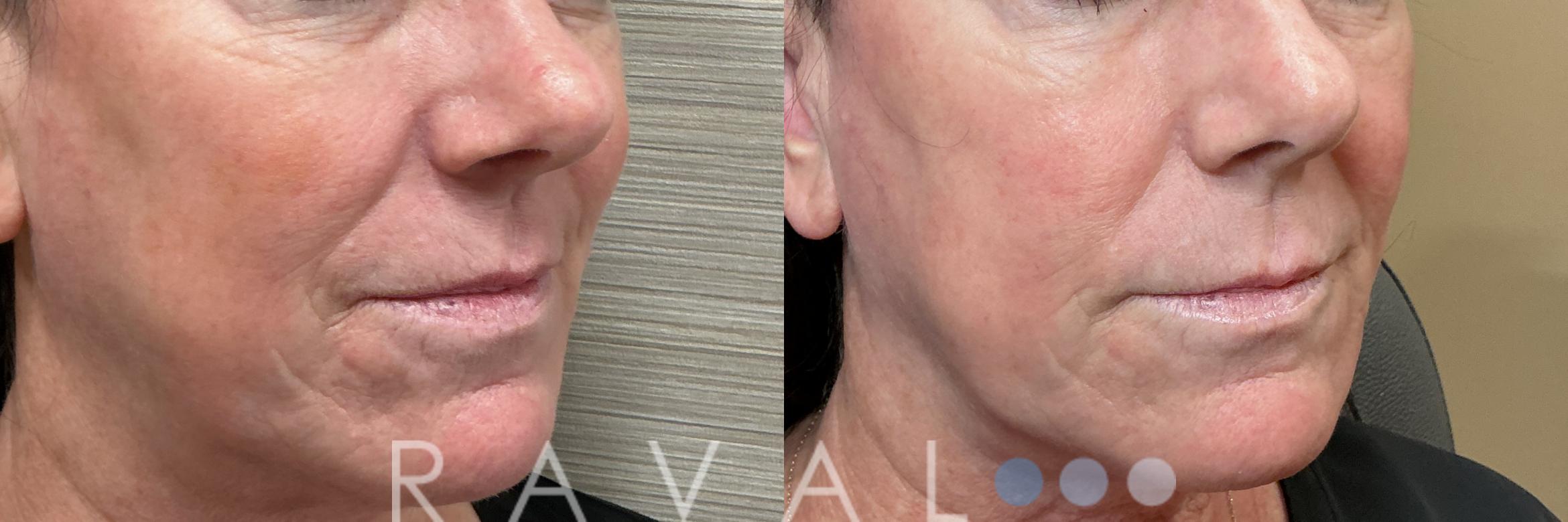 Before & After Botox & Dermal Fillers Case 1196 View 3 View in Denver, CO