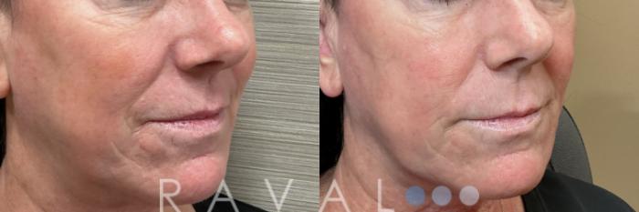 Before & After Botox & Dermal Fillers Case 1196 View 3 View in Denver, CO