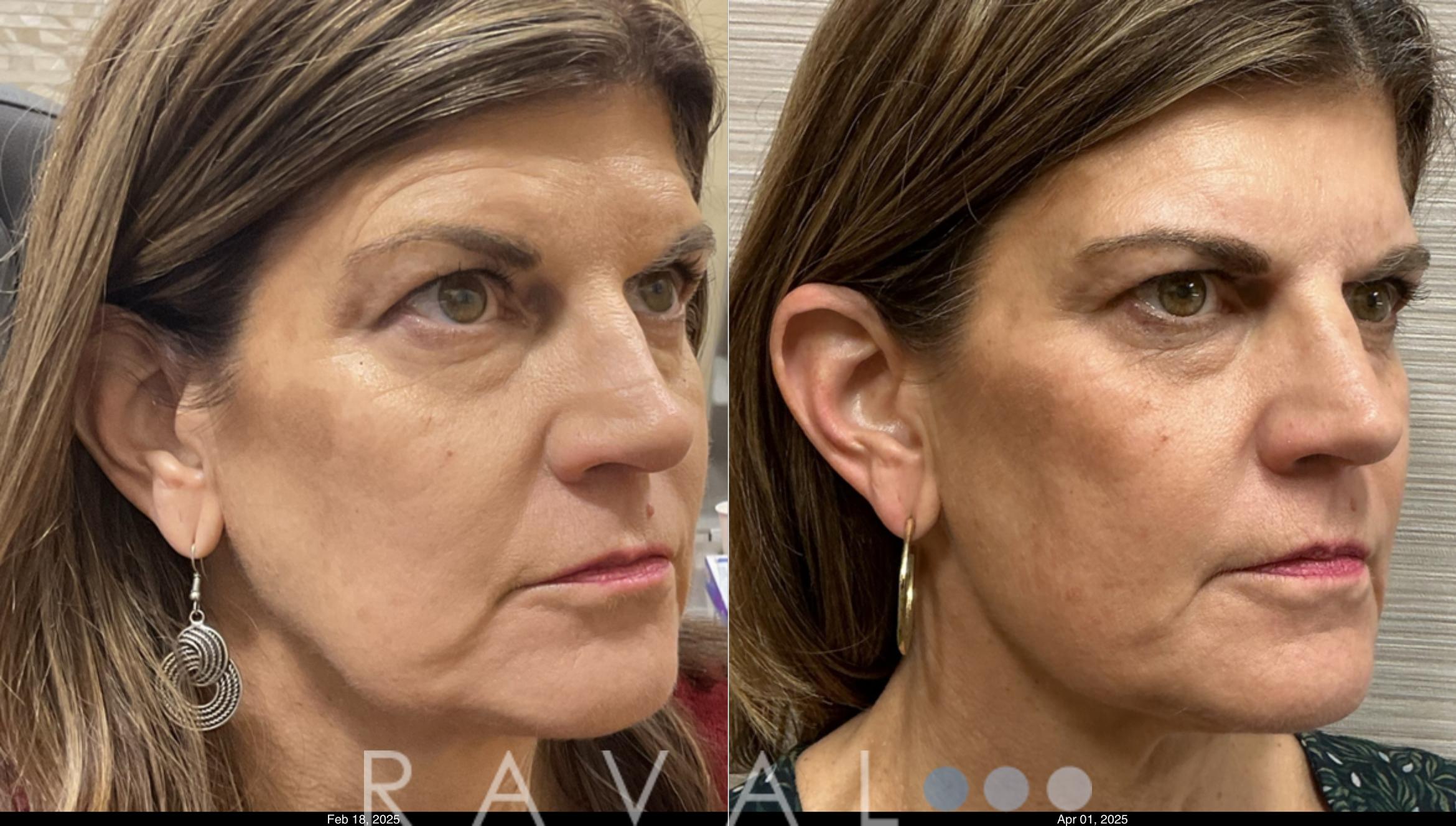 Before & After Botox & Dermal Fillers Case 1197 View 1 View in Denver, CO