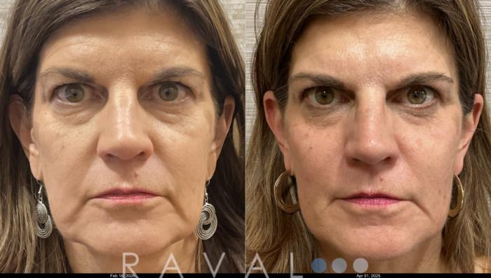Before & After Botox & Dermal Fillers Case 1197 View 2 View in Denver, CO