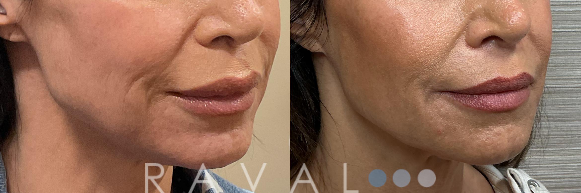 Before & After Botox & Dermal Fillers Case 1198 View 1 View in Denver, CO