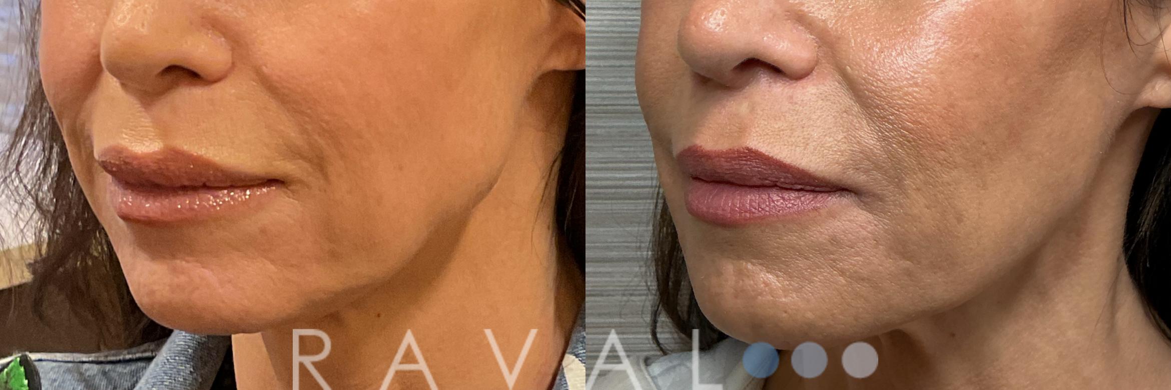 Before & After Botox & Dermal Fillers Case 1198 View 2 View in Denver, CO