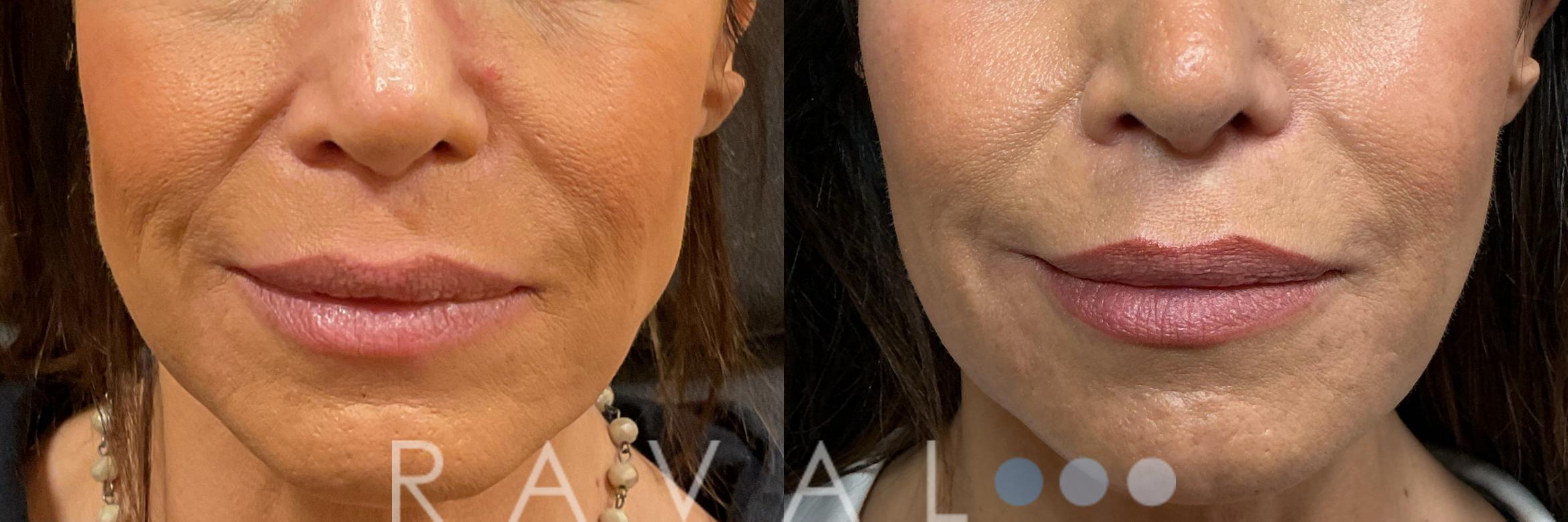Before & After Botox & Dermal Fillers Case 1198 View 3 View in Denver, CO