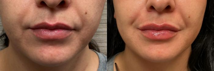 Before & After Botox & Dermal Fillers Case 1199 View 1 View in Denver, CO