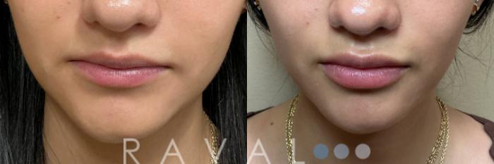 Before & After Botox & Dermal Fillers Case 1200 View 1 View in Denver, CO