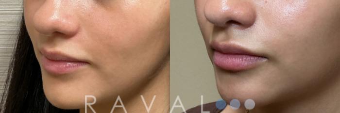 Before & After Botox & Dermal Fillers Case 1200 View 2 View in Denver, CO