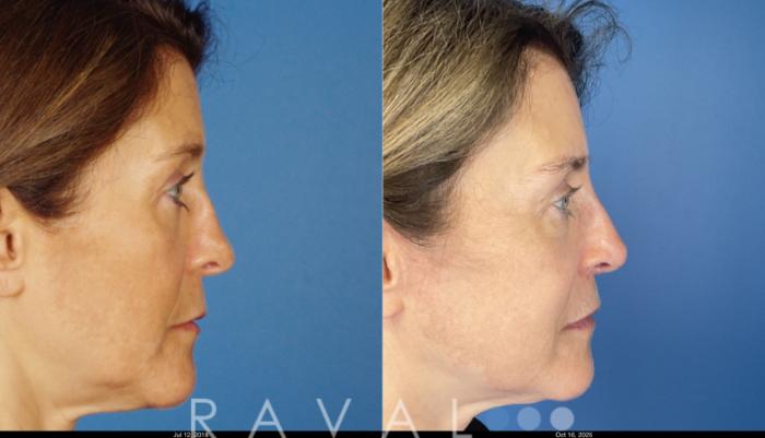 Before & After Botox & Dermal Fillers Case 1201 View 1 View in Denver, CO