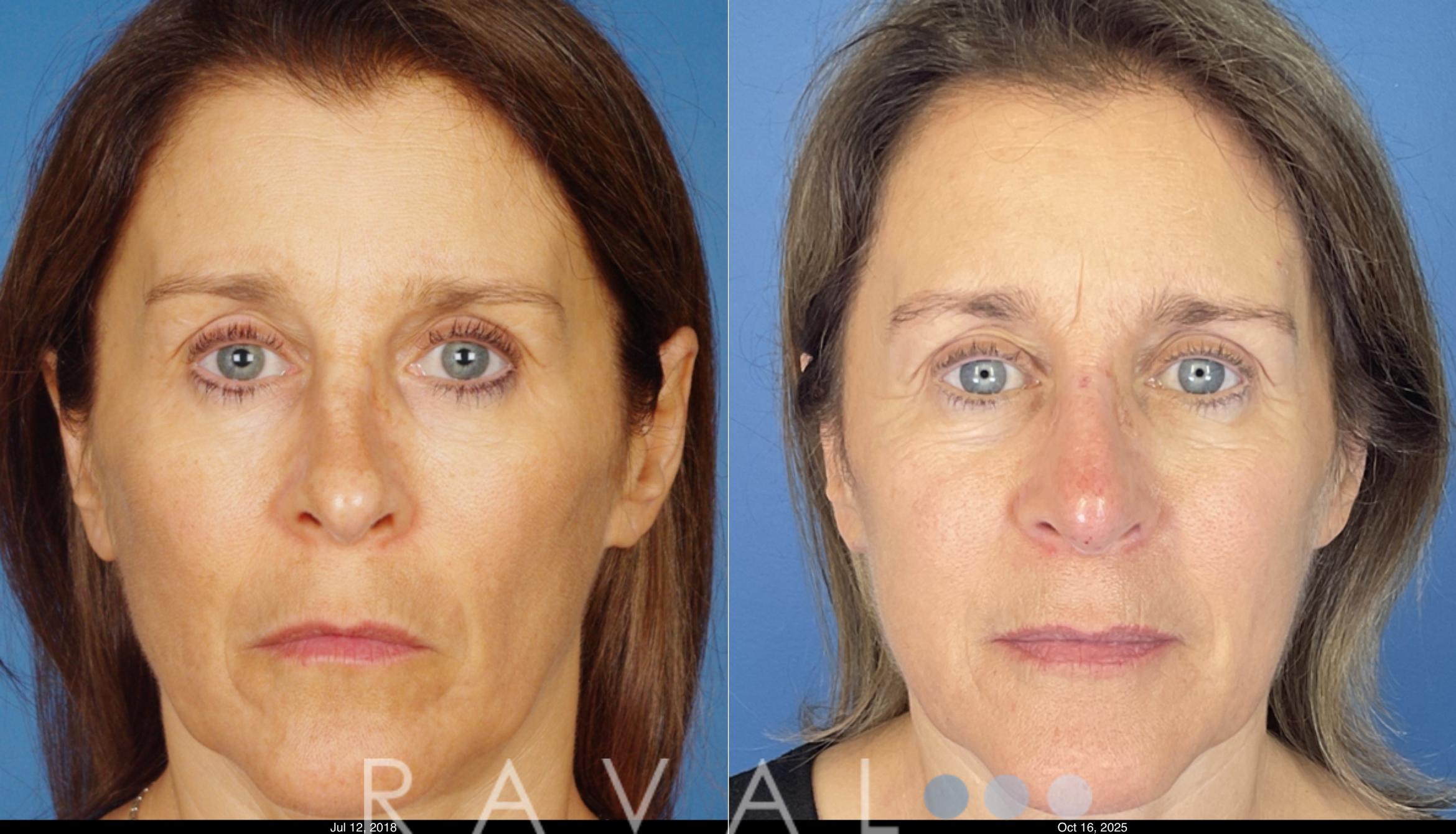 Before & After Botox & Dermal Fillers Case 1201 View 2 View in Denver, CO