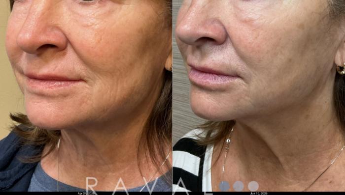 Before & After Botox & Dermal Fillers Case 1202 View 1 View in Denver, CO