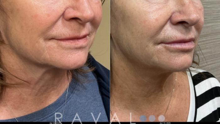 Before & After Botox & Dermal Fillers Case 1202 View 2 View in Denver, CO