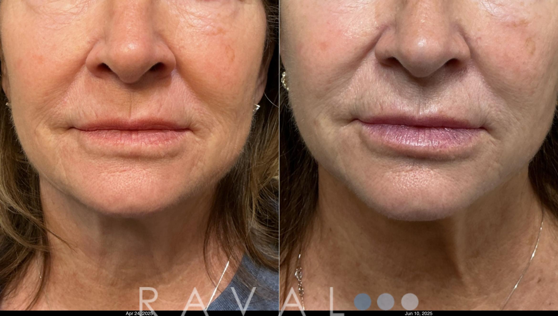Before & After Botox & Dermal Fillers Case 1202 View 3 View in Denver, CO