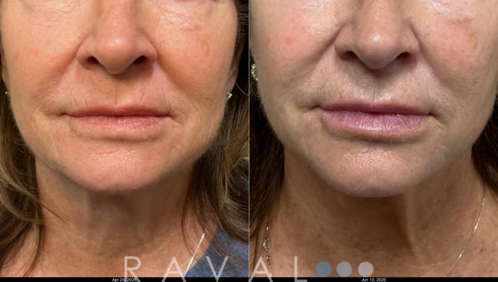Before & After Botox & Dermal Fillers Case 1202 View 3 View in Denver, CO