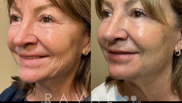 Before & After Botox & Dermal Fillers Case 1202 View 4 View in Denver, CO