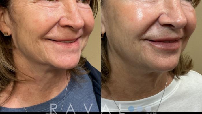 Before & After Botox & Dermal Fillers Case 1202 View 5 View in Denver, CO