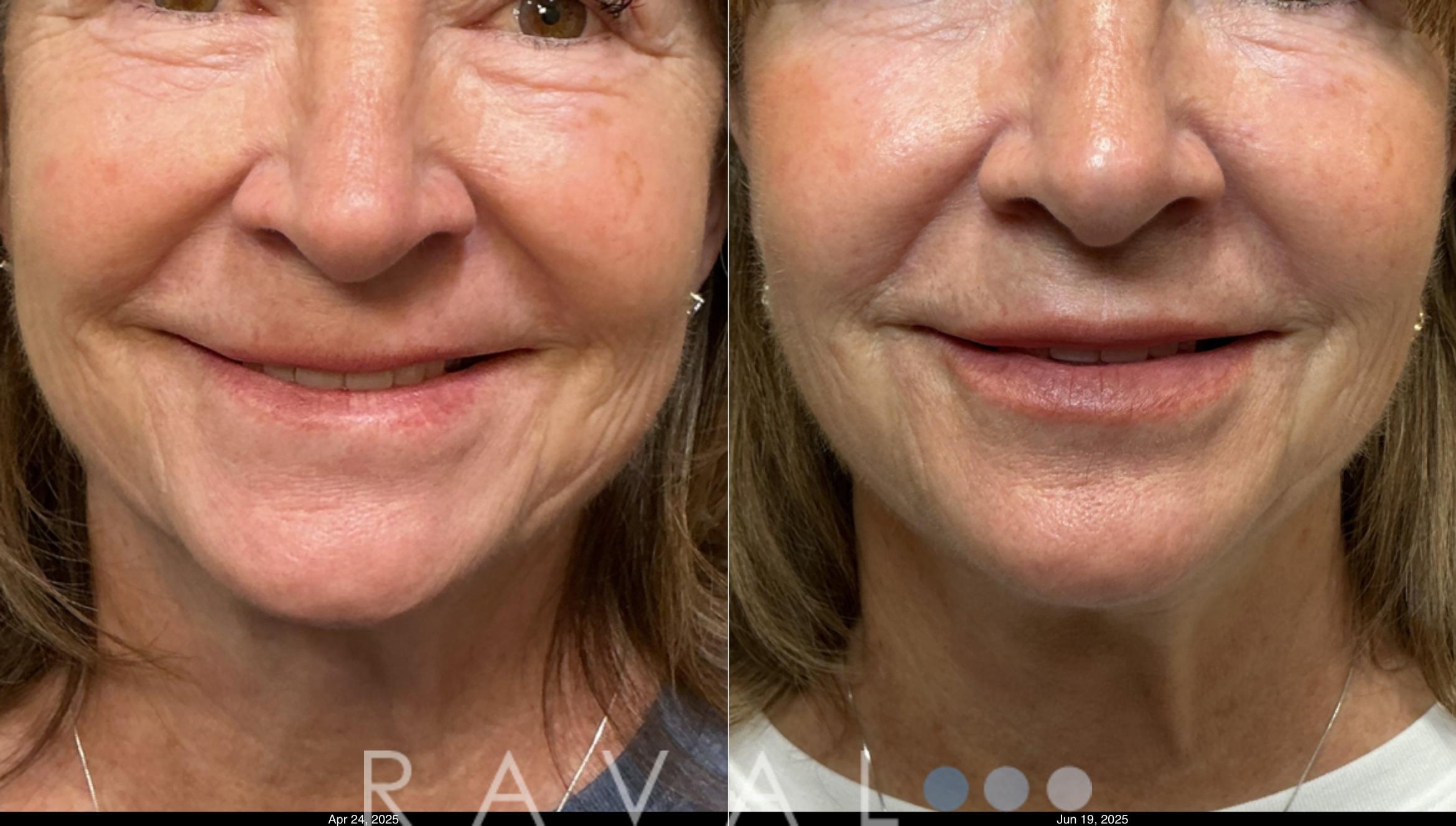 Before & After Botox & Dermal Fillers Case 1202 View 6 View in Denver, CO