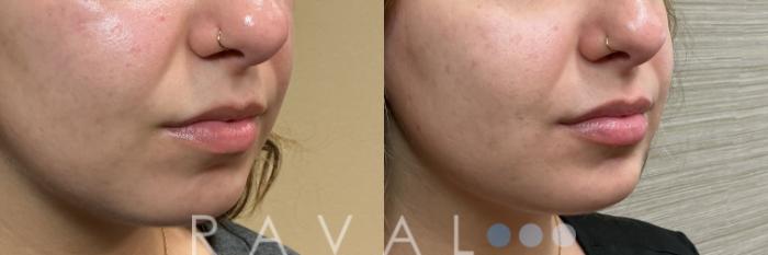 Before & After Botox & Dermal Fillers Case 1203 View 1 View in Denver, CO