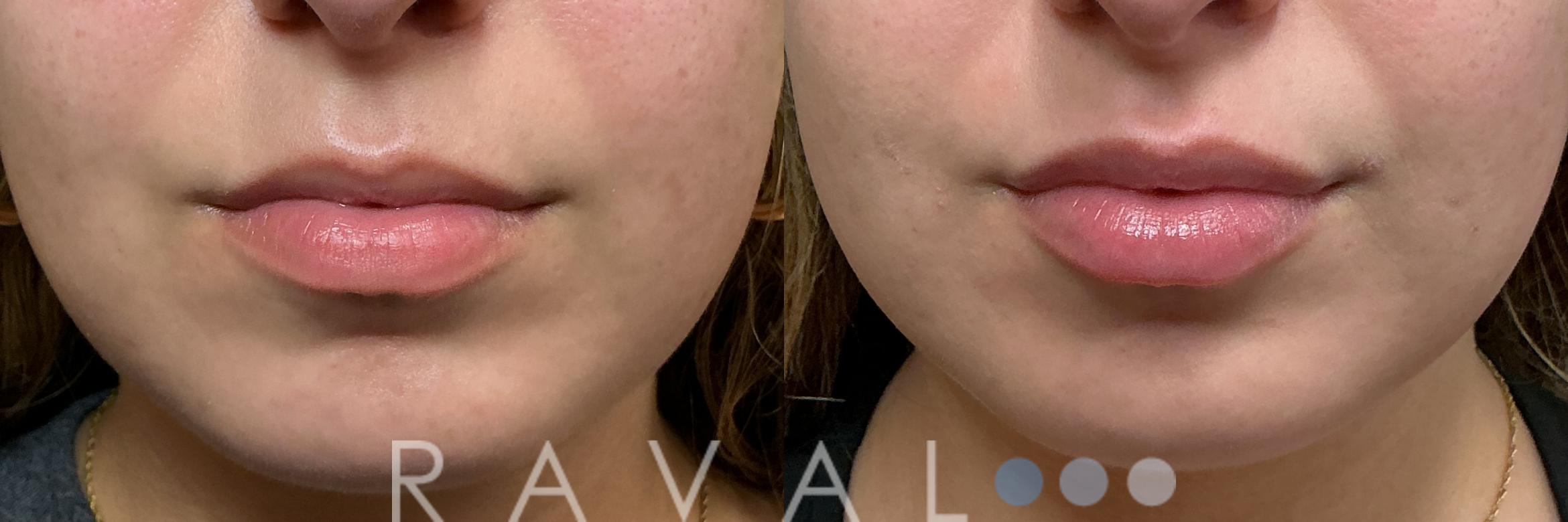 Before & After Botox & Dermal Fillers Case 1203 View 2 View in Denver, CO