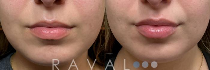 Before & After Botox & Dermal Fillers Case 1203 View 2 View in Denver, CO