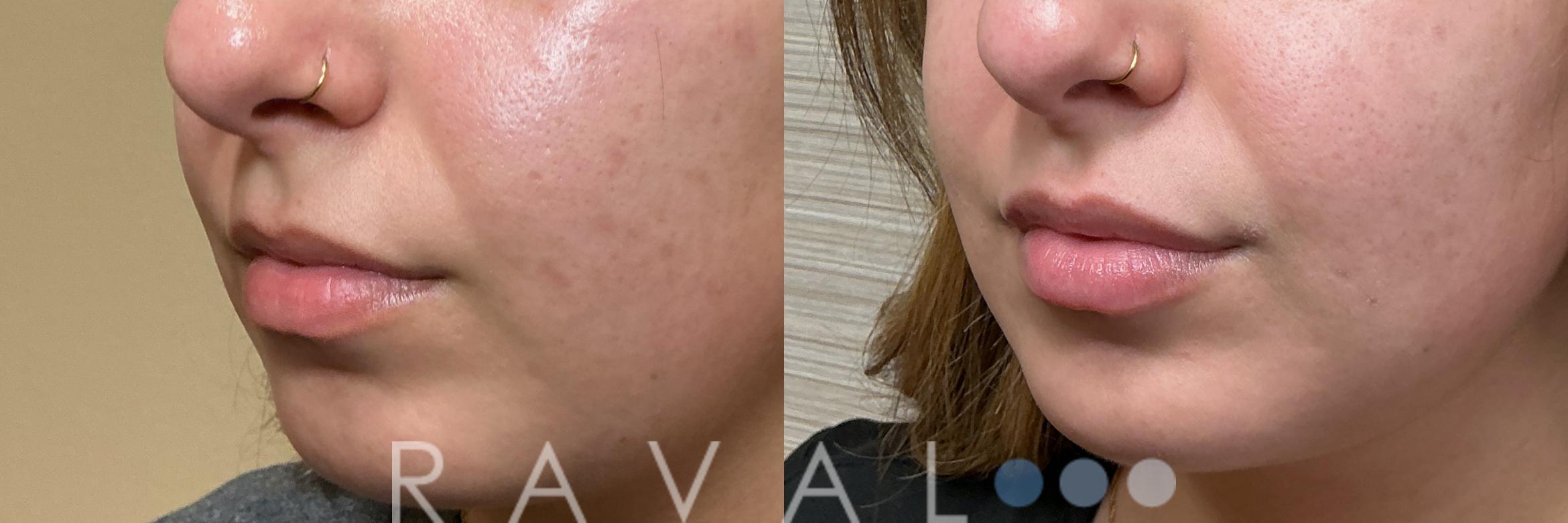 Before & After Botox & Dermal Fillers Case 1203 View 3 View in Denver, CO