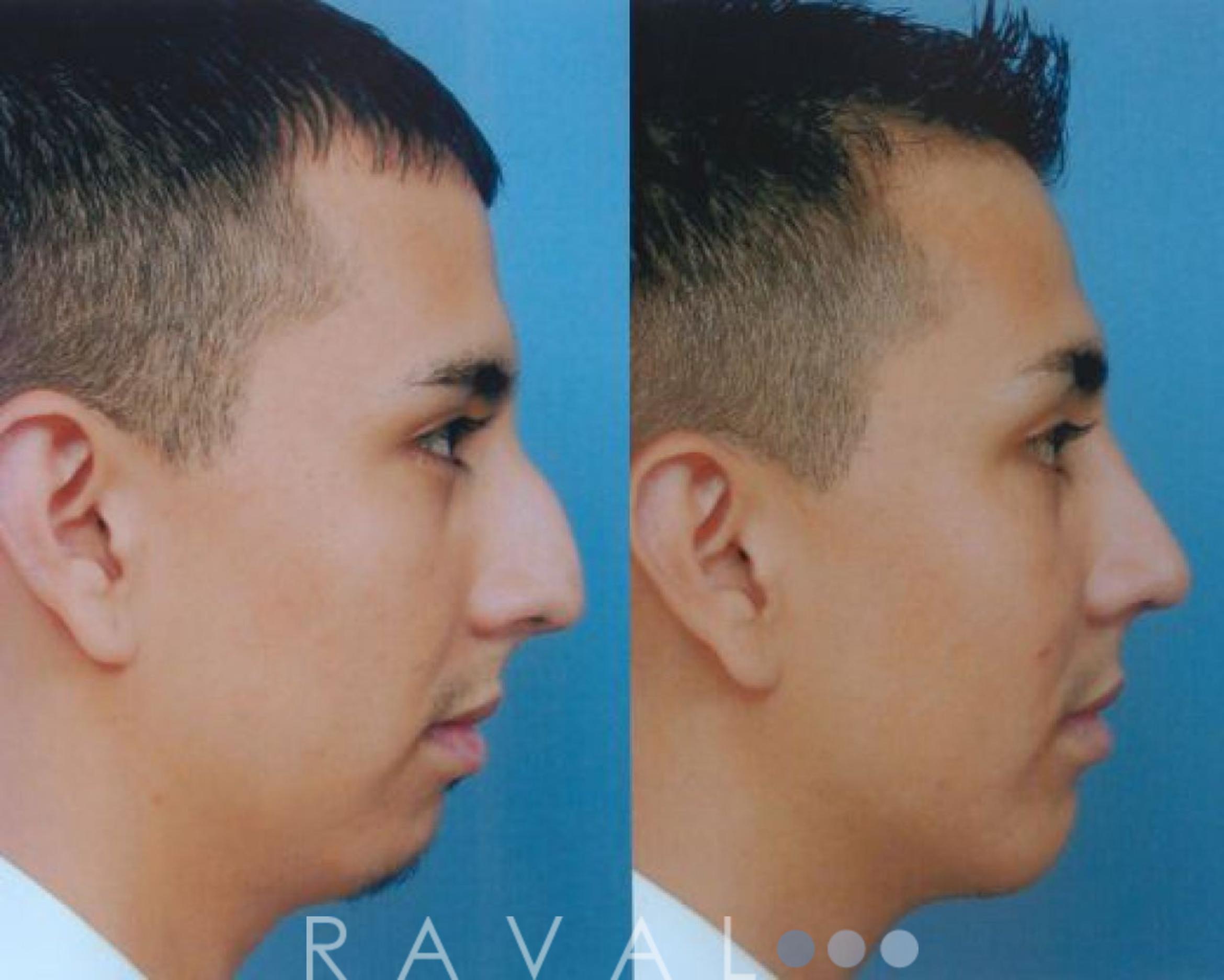 Before & After Chin Augmentation Case 1053 View 1 View in Denver, CO