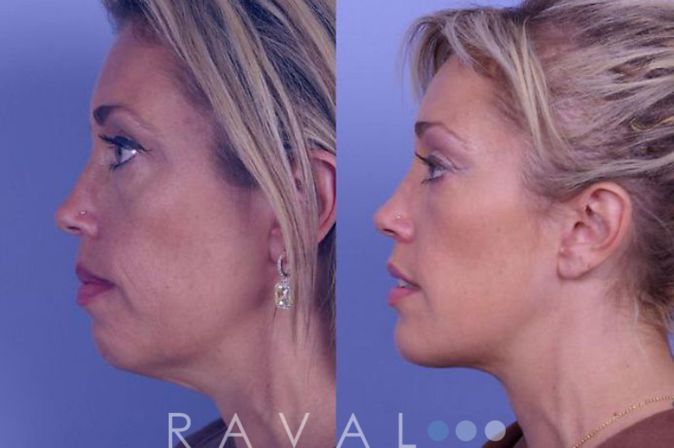 Before & After Chin Augmentation Case 1055 View 1 View in Denver, CO