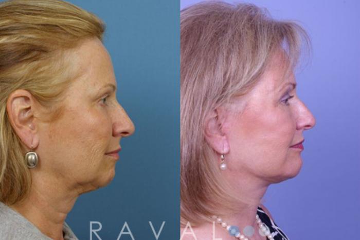 Before & After Chin Augmentation Case 1056 View 1 View in Denver, CO