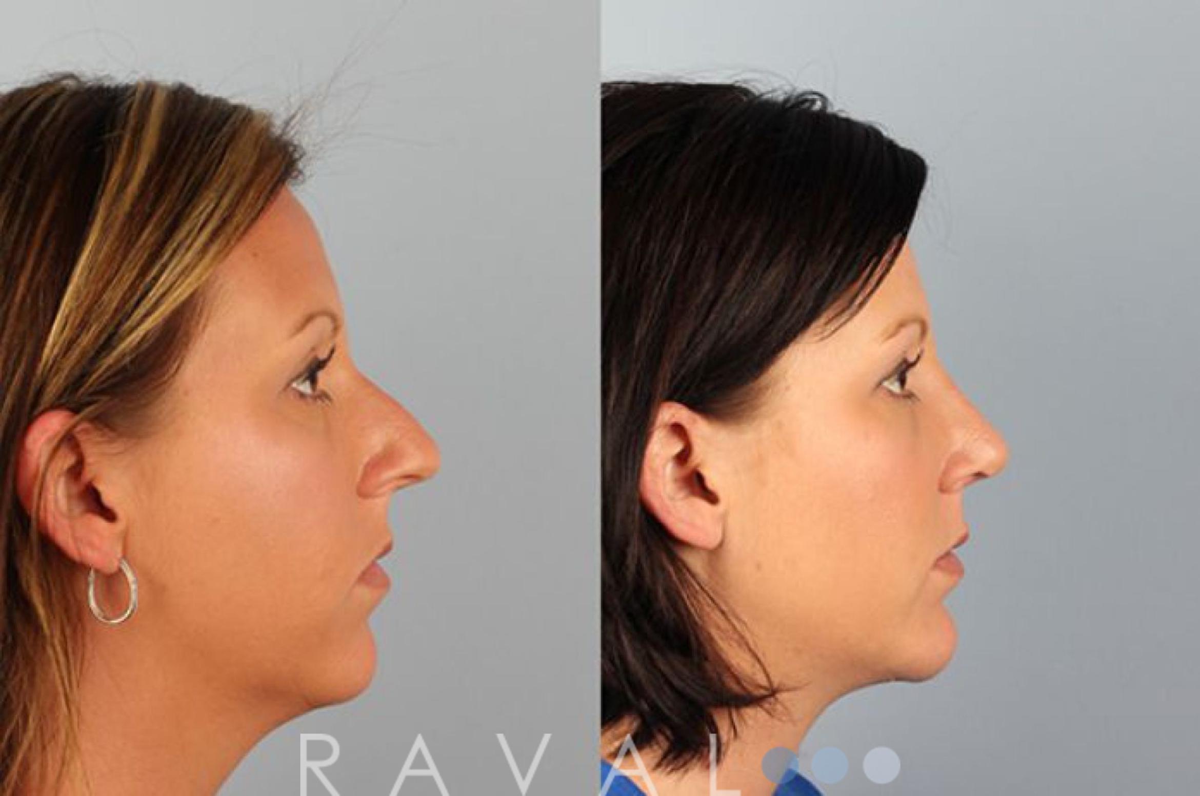 Before & After Chin Augmentation Case 1057 View 1 View in Denver, CO