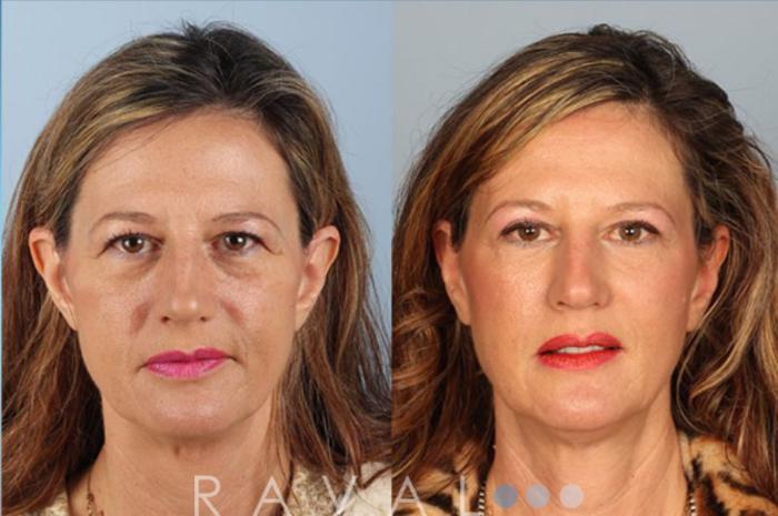Before & After Eyelid Lifts Case 1058 View 1 View in Denver, CO