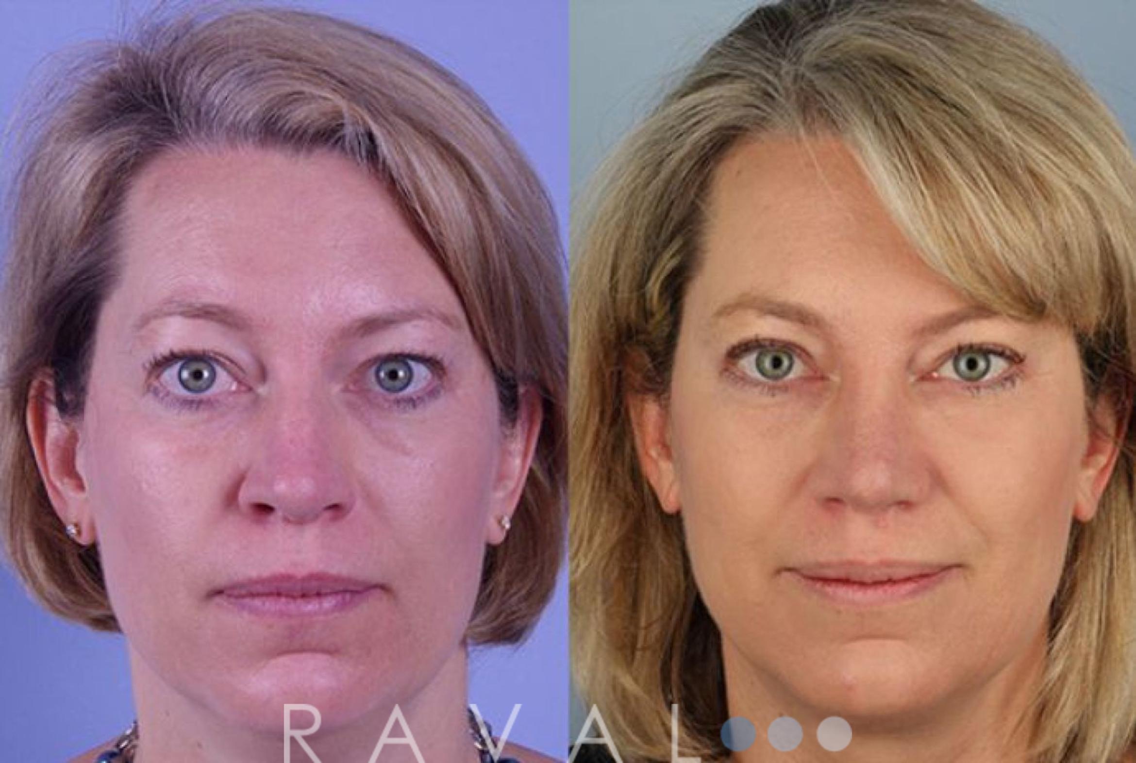 Before & After Eyelid Lifts Case 1059 View 1 View in Denver, CO