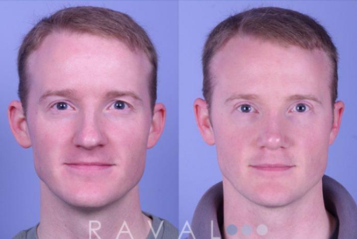 Before & After Eyelid Lifts Case 1060 View 1 View in Denver, CO