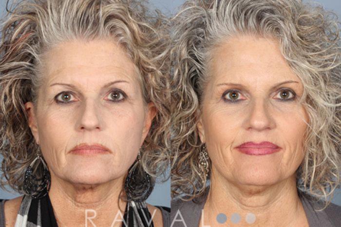Before & After Eyelid Lifts Case 1061 View 1 View in Denver, CO