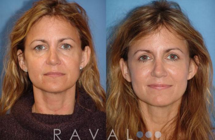 Before & After Eyelid Lifts Case 1062 View 1 View in Denver, CO