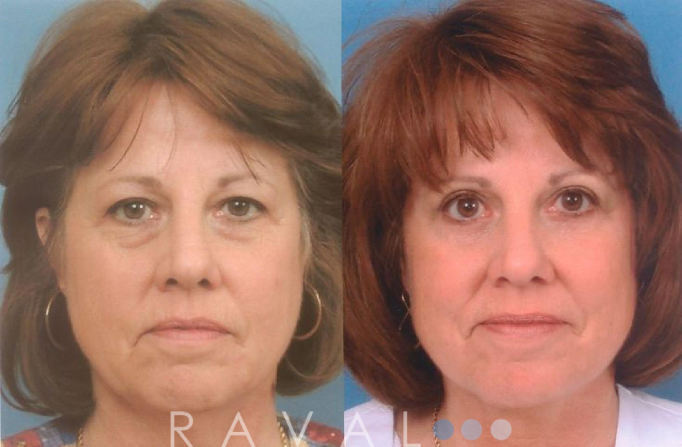 Before & After Eyelid Lifts Case 1063 View 1 View in Denver, CO