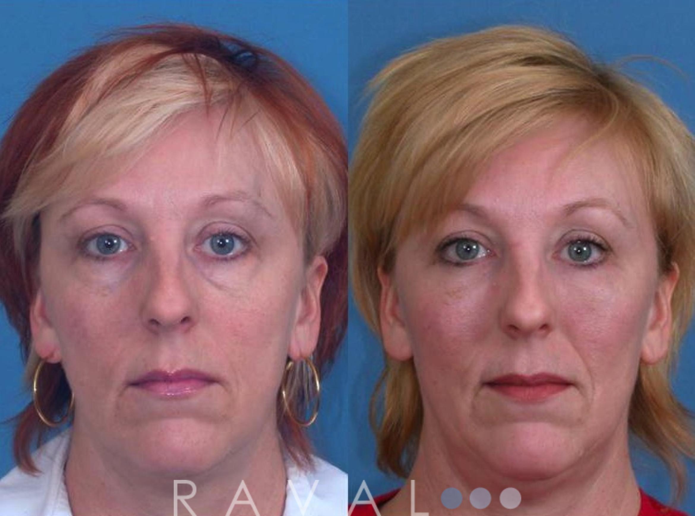 Before & After Eyelid Lifts Case 1064 View 1 View in Denver, CO