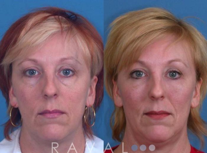 Before & After Eyelid Lifts Case 1064 View 1 View in Denver, CO
