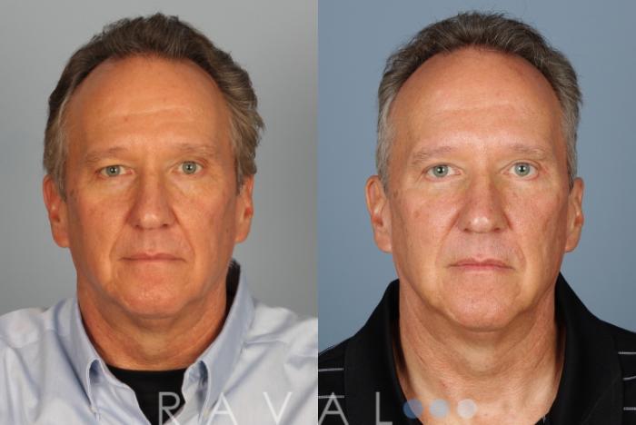 Before & After Eyelid Lifts Case 1065 View 1 View in Denver, CO
