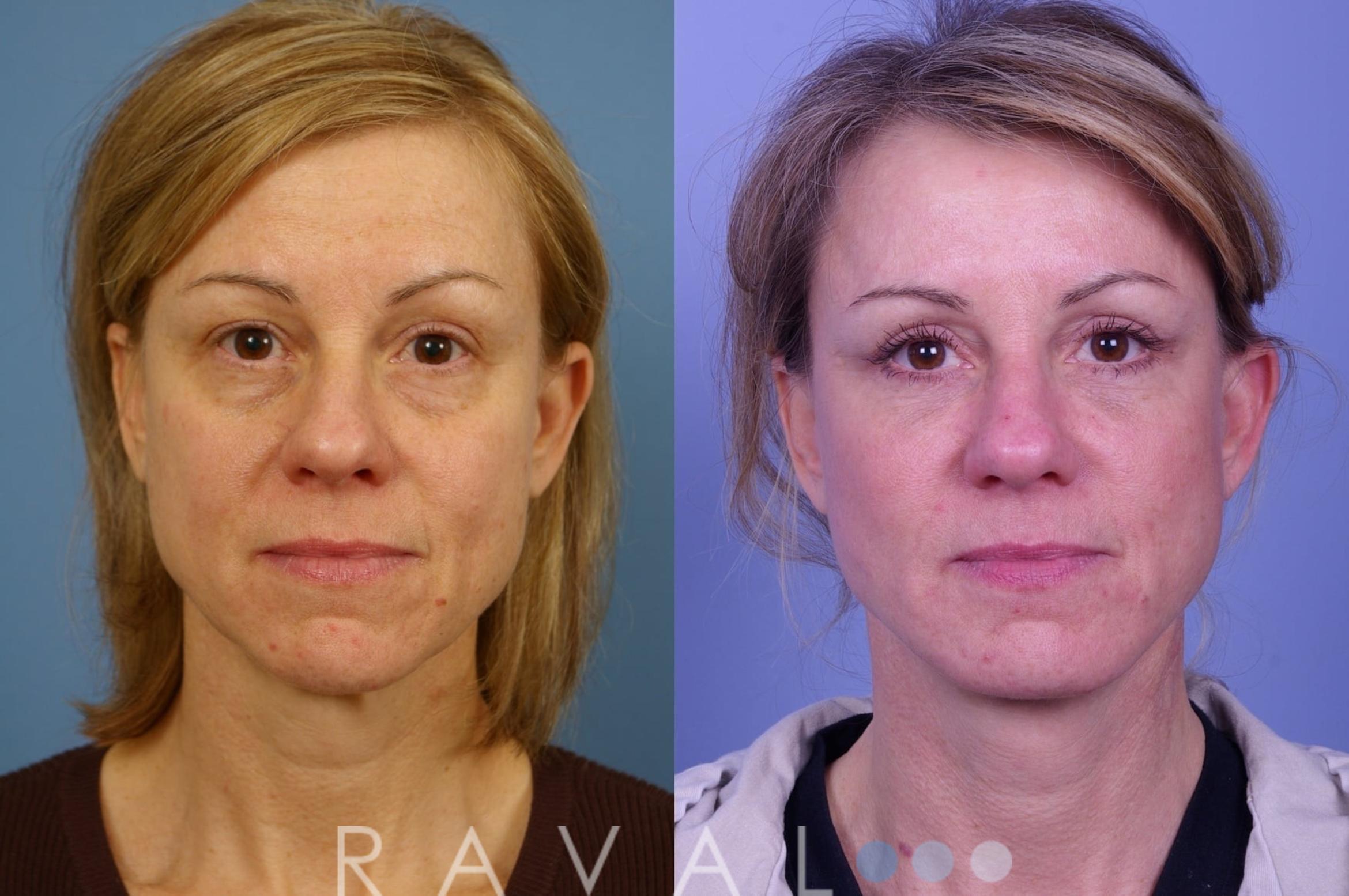 Before & After Eyelid Lifts Case 1066 View 1 View in Denver, CO