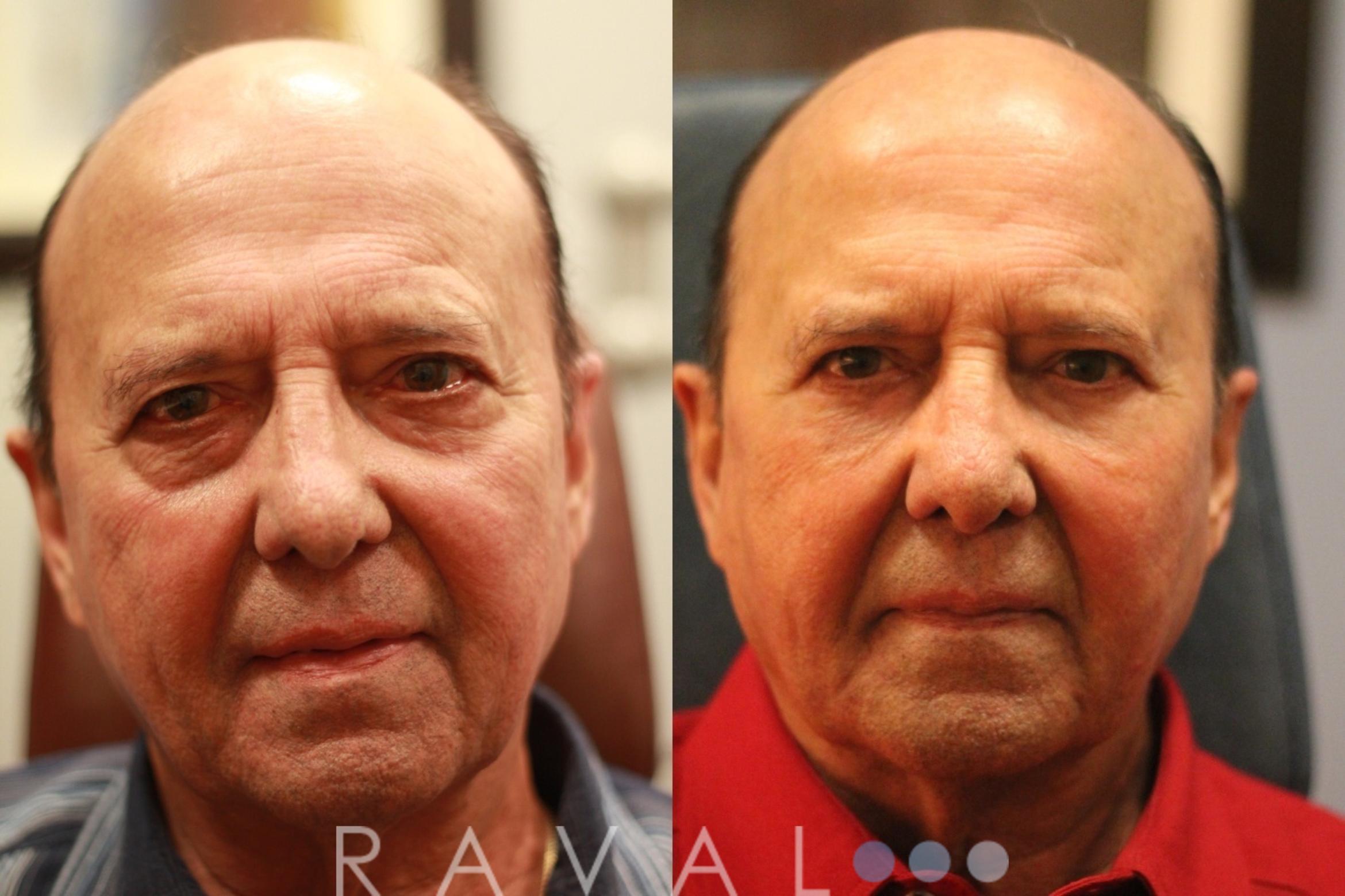 Before & After Eyelid Lifts Case 1067 View 1 View in Denver, CO