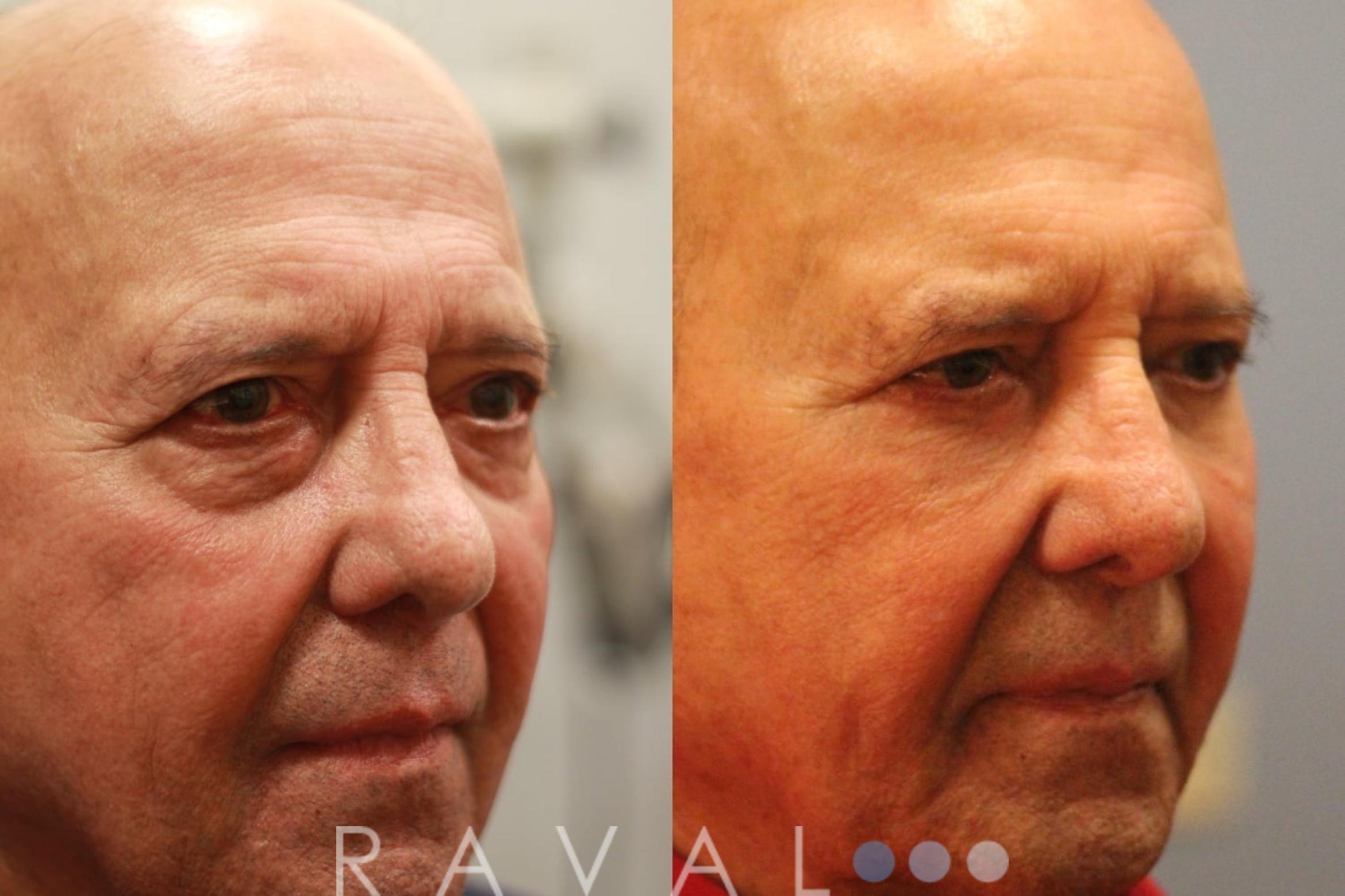 Before & After Eyelid Lifts Case 1067 View 2 View in Denver, CO