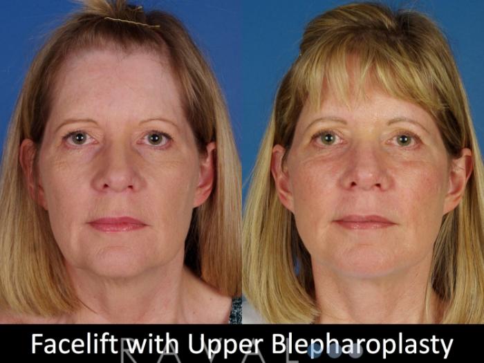 Before & After Eyelid Lifts Case 1068 View 1 View in Denver, CO