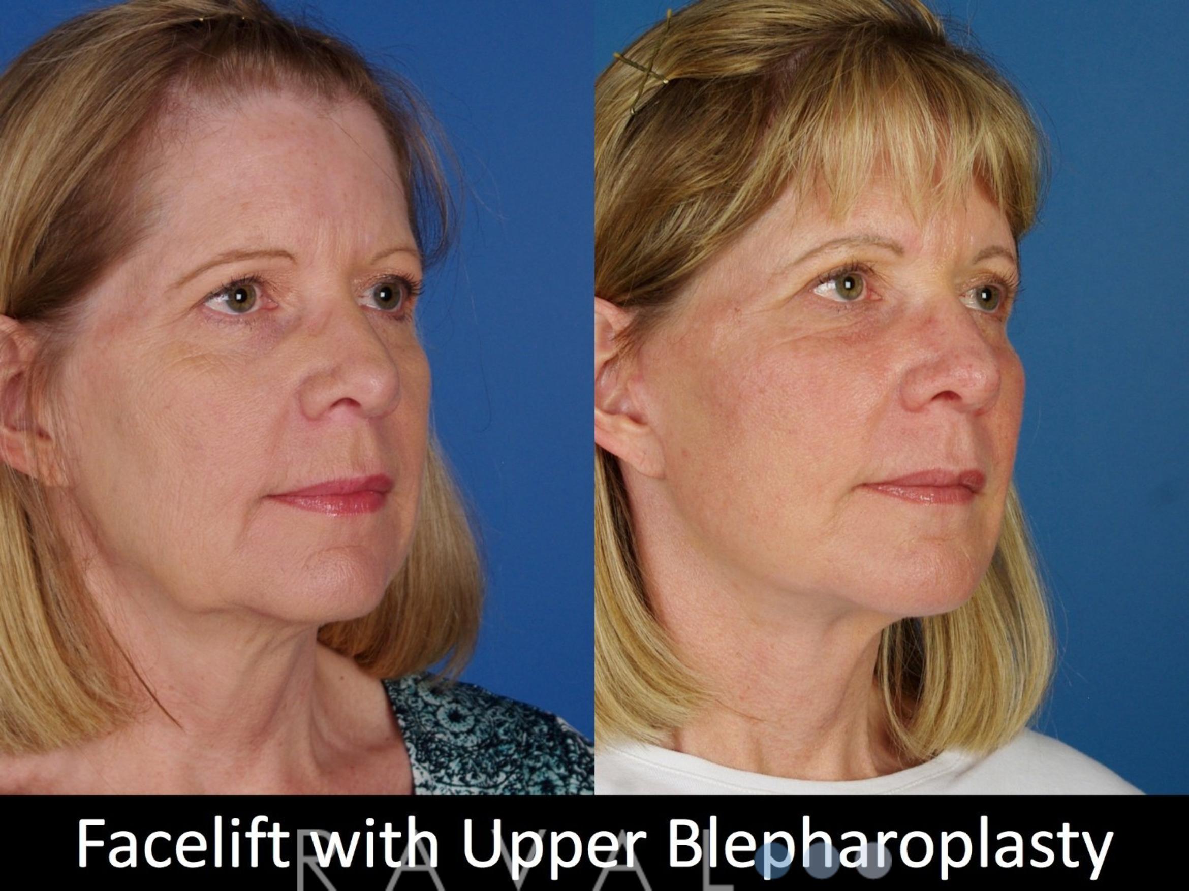 Before & After Eyelid Lifts Case 1068 View 2 View in Denver, CO